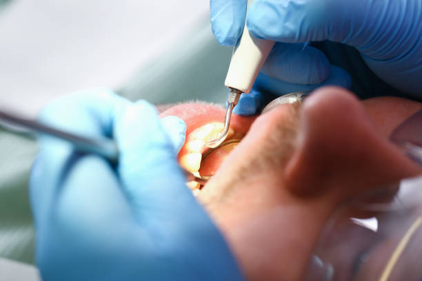 Best Emergency Dentist for Knocked-Out Tooth in Clarcona, FL